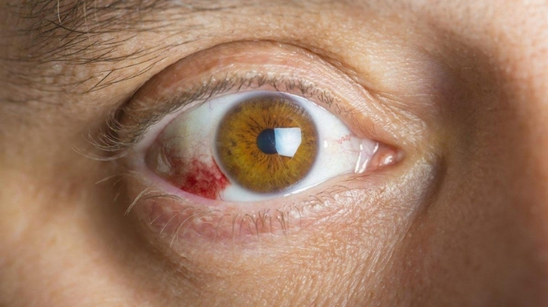 Popped blood vessel on the white of the eye showing a subconjunctival haemorrhage